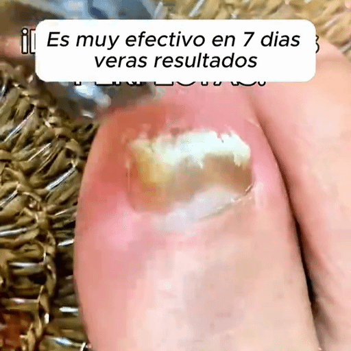 7 Dias Tratamiento para Hongos Uñas – Pies y Manos (30 ml)